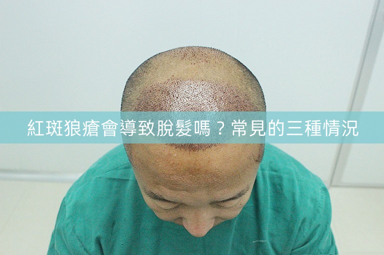 紅斑狼瘡會導致脫髮嗎？常見的三種情況