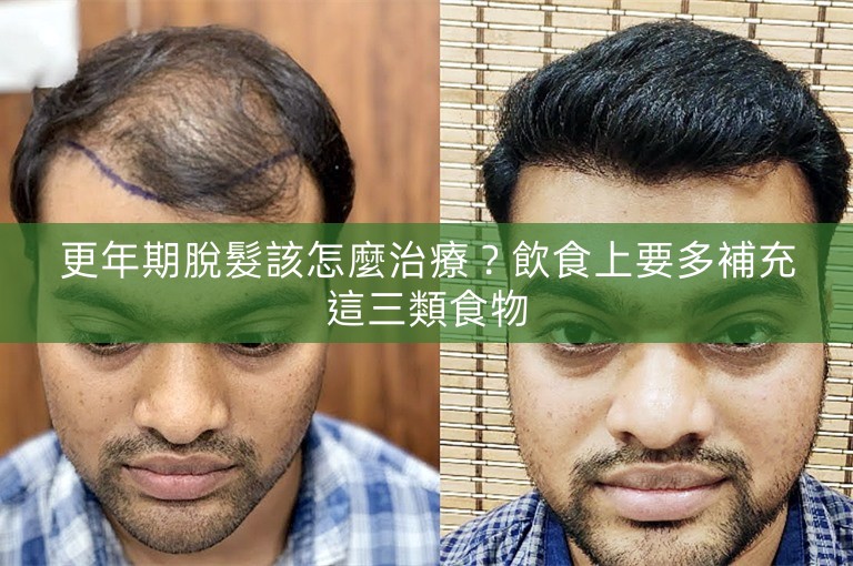 更年期脫髮該怎麼治療？飲食上要多補充這三類食物