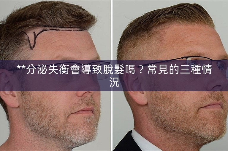**分泌失衡會導致脫髮嗎？常見的三種情況