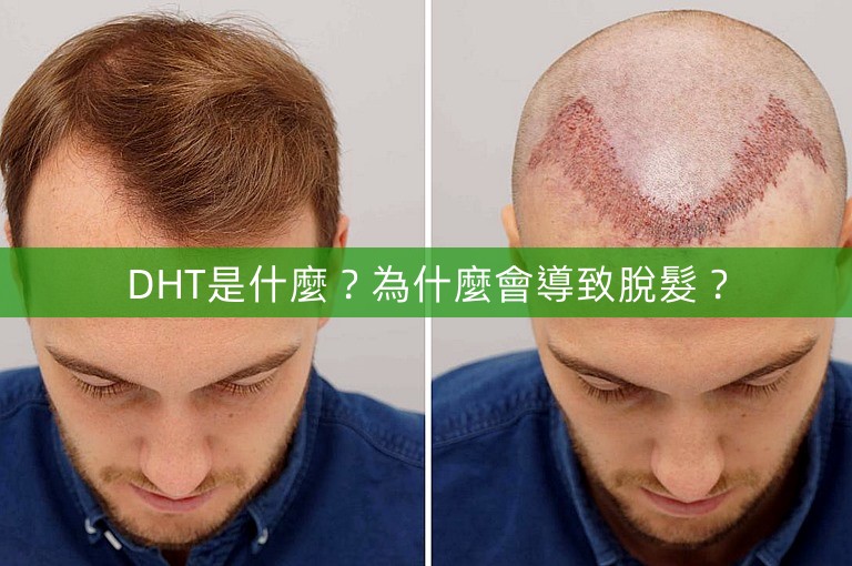 DHT是什麼？為什麼會導致脫髮？