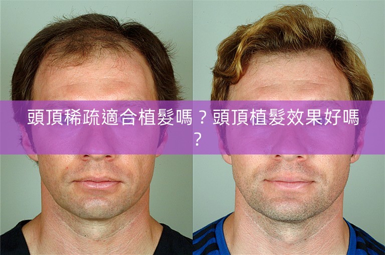 頭頂稀疏適合植髮嗎？頭頂植髮效果好嗎？