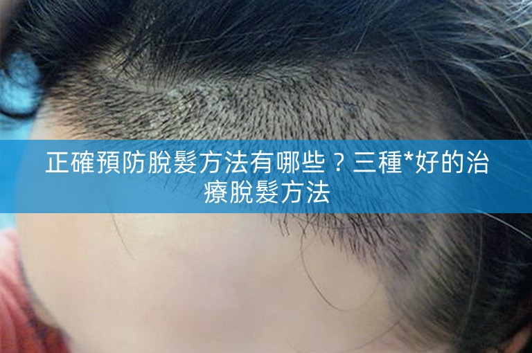 正確預防脫髮方法有哪些？三種*好的治療脫髮方法