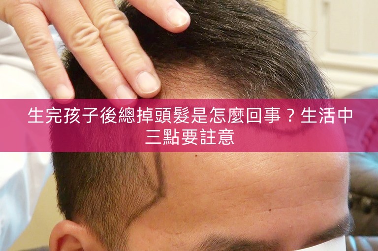 生完孩子後總掉頭髮是怎麼回事？生活中三點要註意