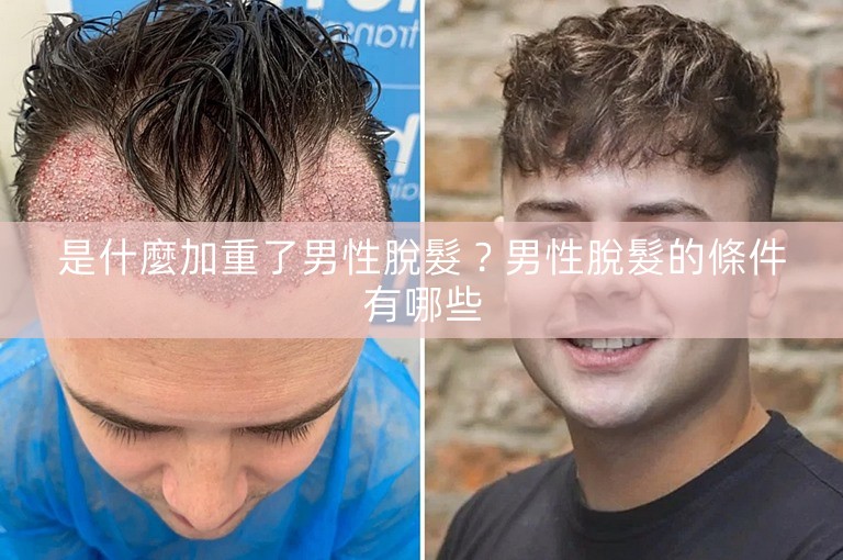 是什麼加重了男性脫髮？男性脫髮的條件有哪些