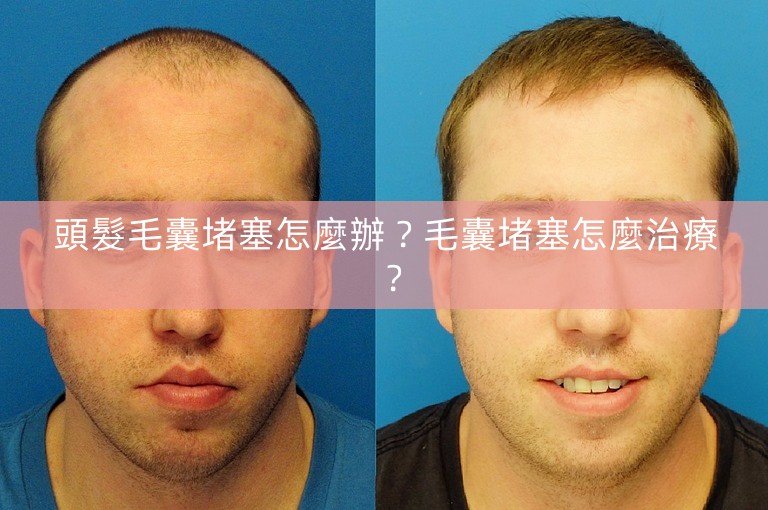 頭髮毛囊堵塞怎麼辦?毛囊堵塞怎麼治療? 頭髮毛囊堵塞怎麼辦?毛囊堵塞怎麼治療?