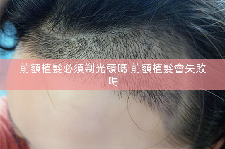 前額植髮必須剃光頭嗎 前額植髮會失敗嗎