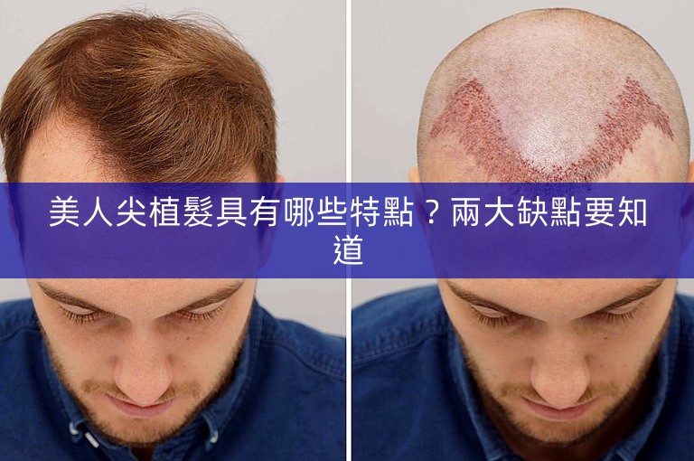 美人尖植髮具有哪些特點？兩大缺點要知道