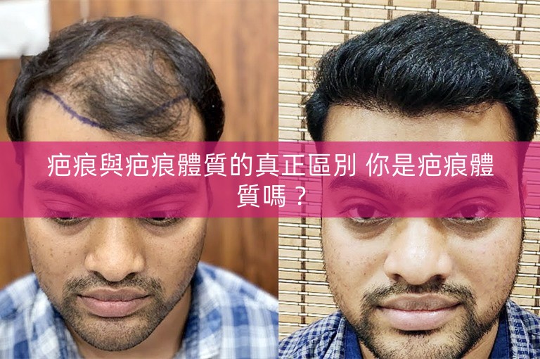 疤痕與疤痕體質的真正區別 你是疤痕體質嗎？