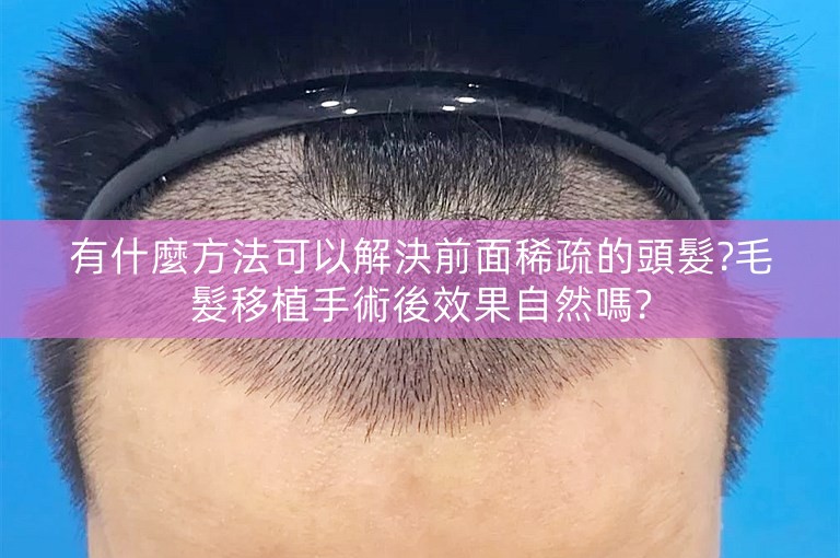 有什麼方法可以解決前面稀疏的頭髮?毛髮移植手術後效果自然嗎?