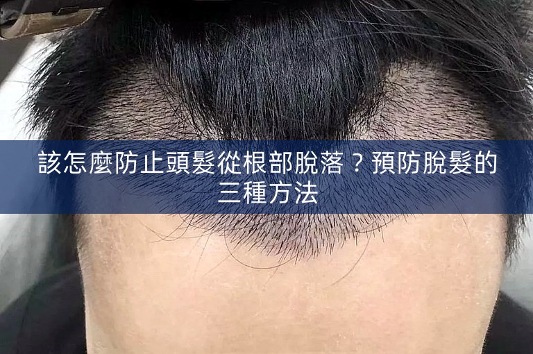 該怎麼防止頭髮從根部脫落?預防脫髮的三種方法 該怎麼防止頭髮從根部脫落?預防脫髮的三種方法