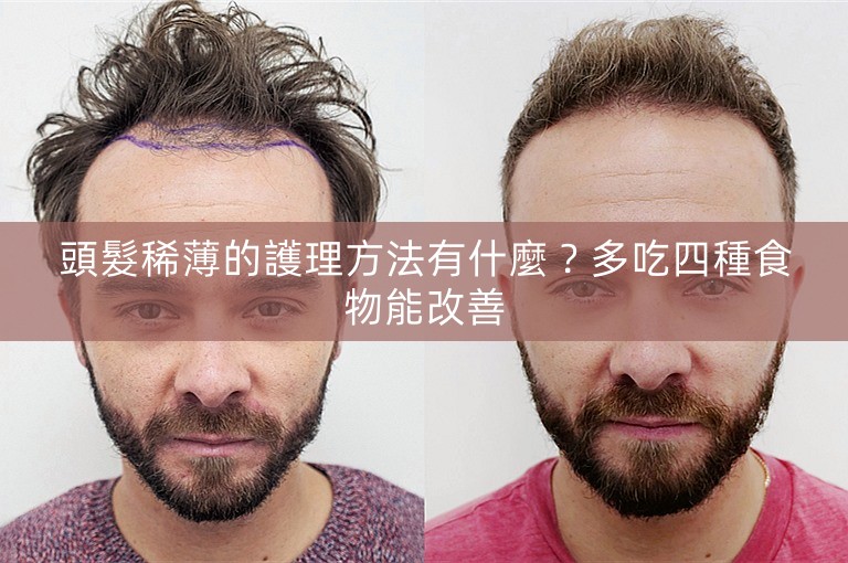 頭髮稀薄的護理方法有什麼?多吃四種食物能改善 頭髮稀薄的護理方法有什麼?多吃四種食物能改善