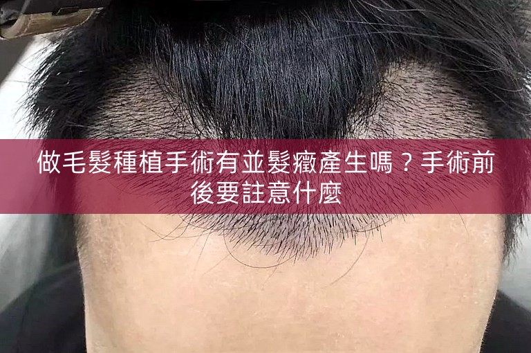做毛髮種植手術有並髮癥產生嗎？手術前後要註意什麼
