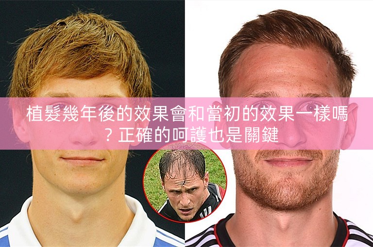 植髮幾年後的效果會和當初的效果一樣嗎？正確的呵護也是關鍵