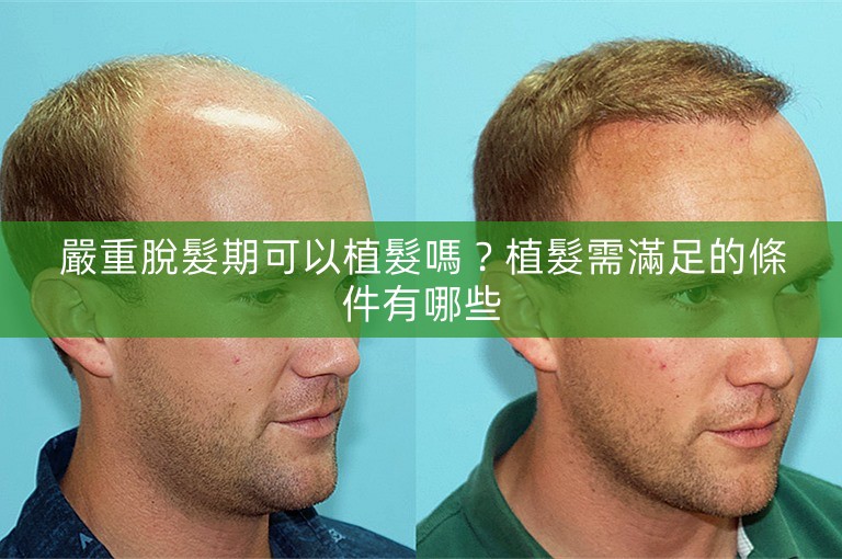 嚴重脫髮期可以植髮嗎?植髮需滿足的條件有哪些 嚴重脫髮期可以植髮嗎?植髮需滿足的條件有哪些