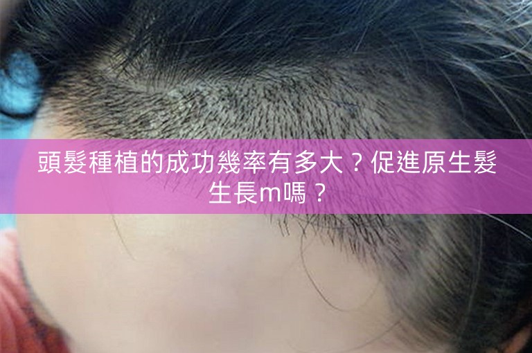 頭髮種植的成功幾率有多大？促進原生髮生長m嗎？