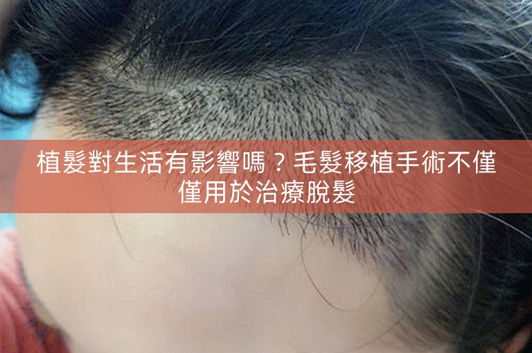 植髮對生活有影響嗎?毛髮移植手術不僅僅用於治療脫髮 植髮對生活有影響嗎?毛髮移植手術不僅僅用於治療脫髮