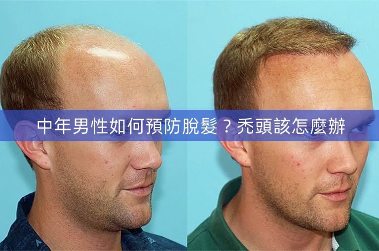 中年男性如何預防脫髮？禿頭該怎麼辦