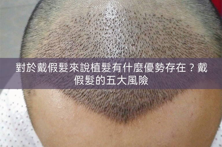 對於戴假髮來說植髮有什麼優勢存在？戴假髮的五大風險