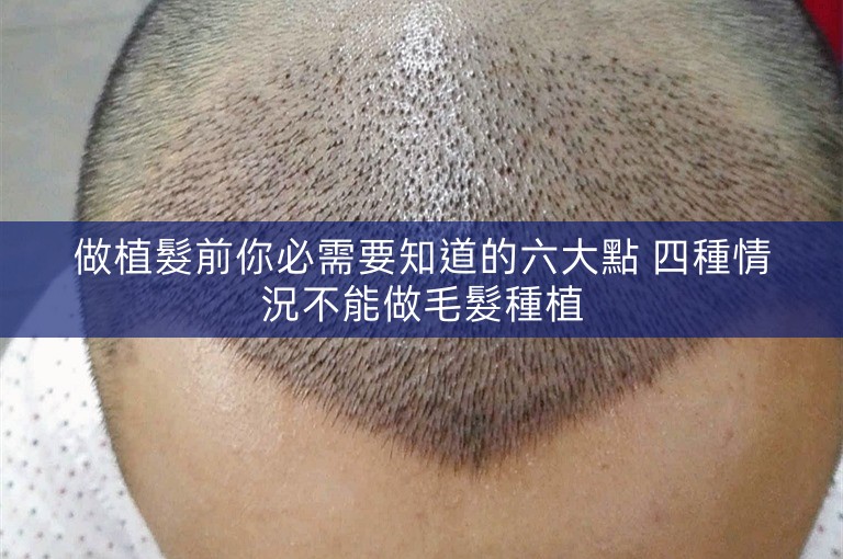 做植髮前你必需要知道的六大點 四種情況不能做毛髮種植