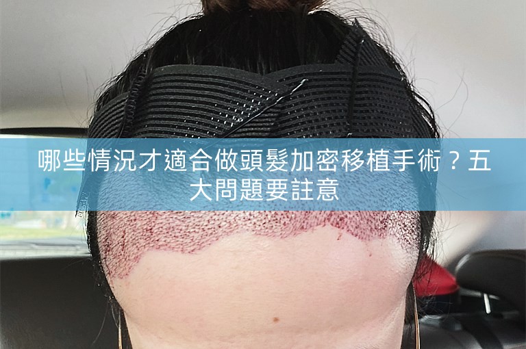 哪些情況才適合做頭髮加密移植手術？五大問題要註意