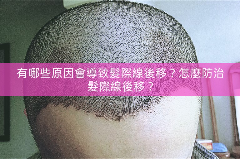 有哪些原因會導致髮際線後移？怎麼防治髮際線後移？