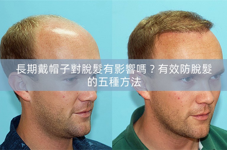 長期戴帽子對脫髮有影響嗎？有效防脫髮的五種方法