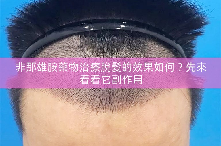 非那雄胺藥物治療脫髮的效果如何？先來看看它副作用
