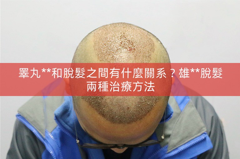 睪丸**和脫髮之間有什麼關系？雄**脫髮兩種治療方法