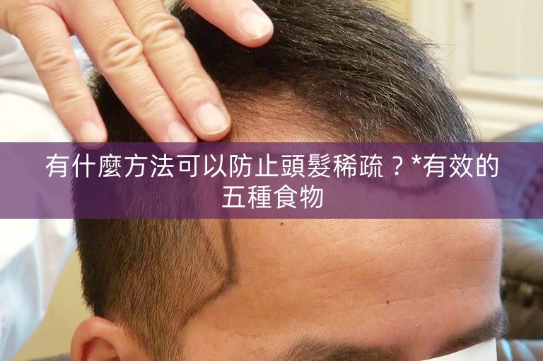 有什麼方法可以防止頭髮稀疏？*有效的五種食物