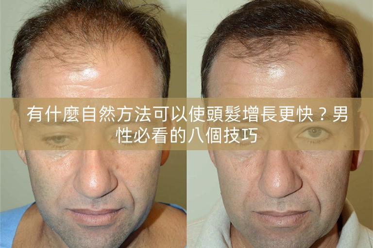 有什麼自然方法可以使頭髮增長更快?男性必看的八個技巧 有什麼自然方法可以使頭髮增長更快?男性必看的八個技巧