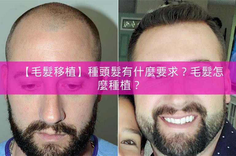 【毛髮移植】種頭髮有什麼要求？毛髮怎麼種植？