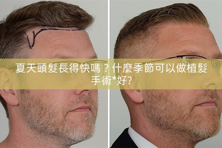 夏天頭髮長得快嗎？什麼季節可以做植髮手術*好?