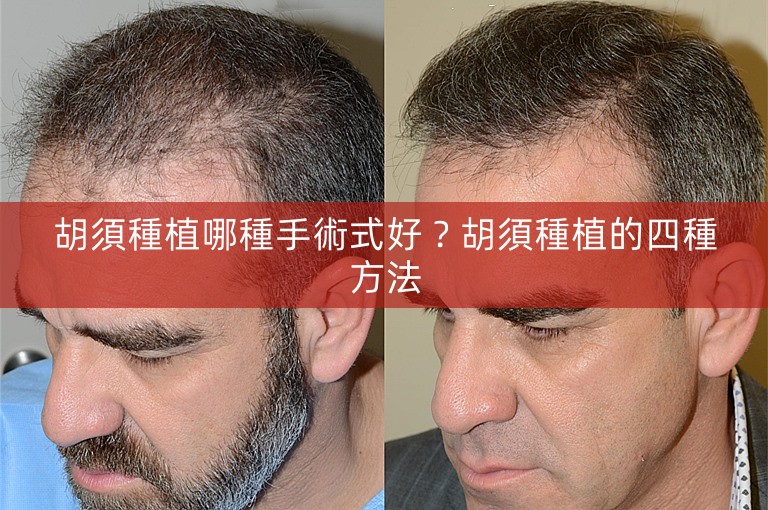 胡須種植哪種手術式好?胡須種植的四種方法 胡須種植哪種手術式好?胡須種植的四種方法