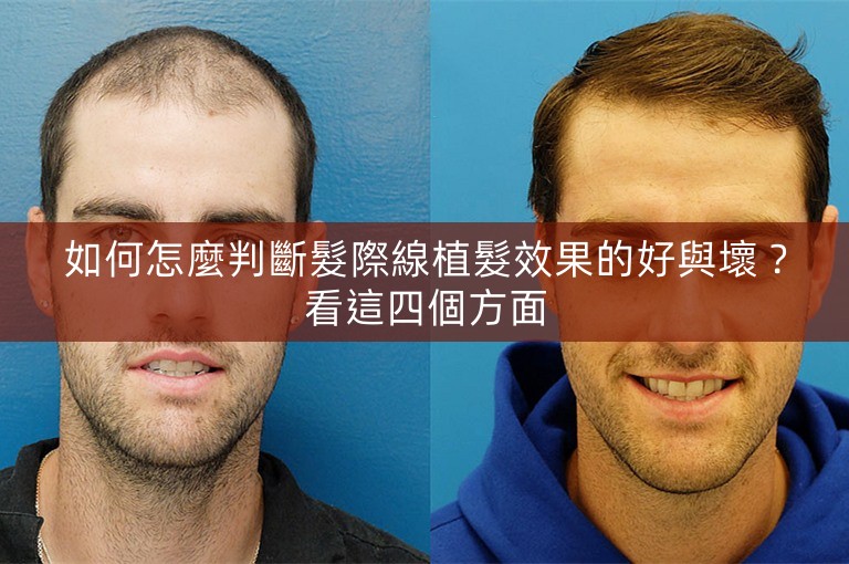 如何怎麼判斷髮際線植髮效果的好與壞？看這四個方面
