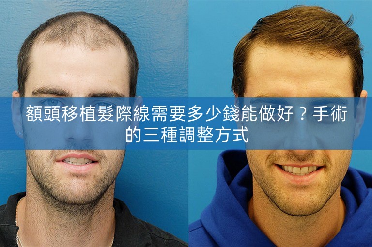 額頭移植髮際線需要多少錢能做好？手術的三種調整方式