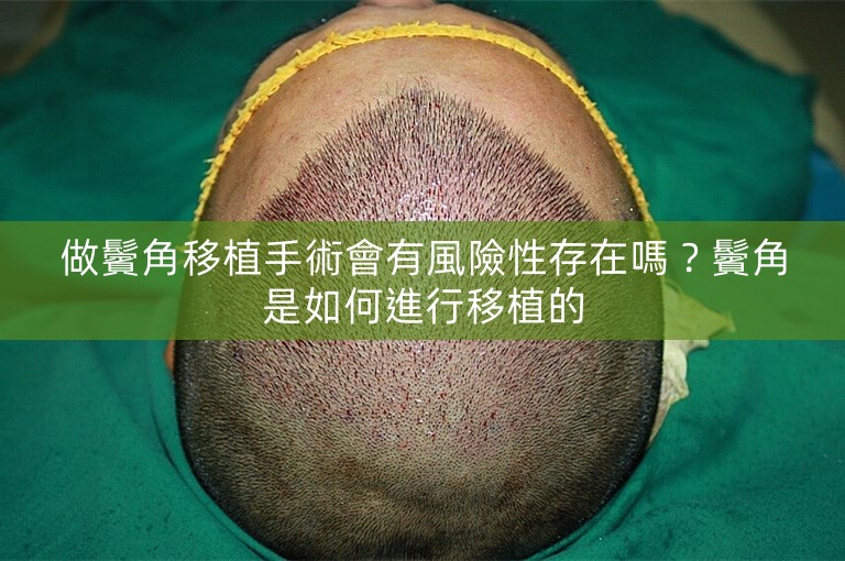 做鬢角移植手術會有風險性存在嗎？鬢角是如何進行移植的
