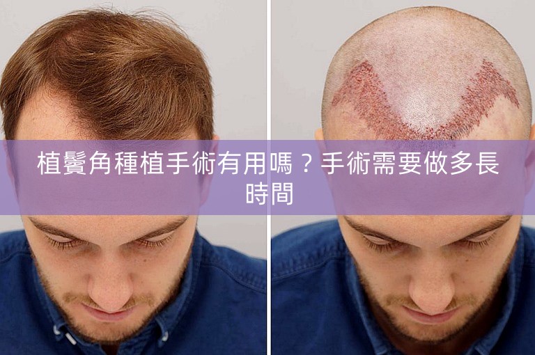 植鬢角種植手術有用嗎？手術需要做多長時間