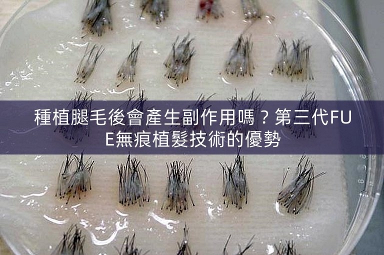 種植腿毛後會產生副作用嗎？第三代FUE無痕植髮技術的優勢