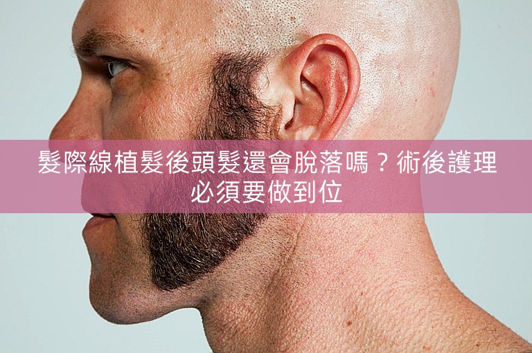 髮際線植髮後頭髮還會脫落嗎？術後護理必須要做到位