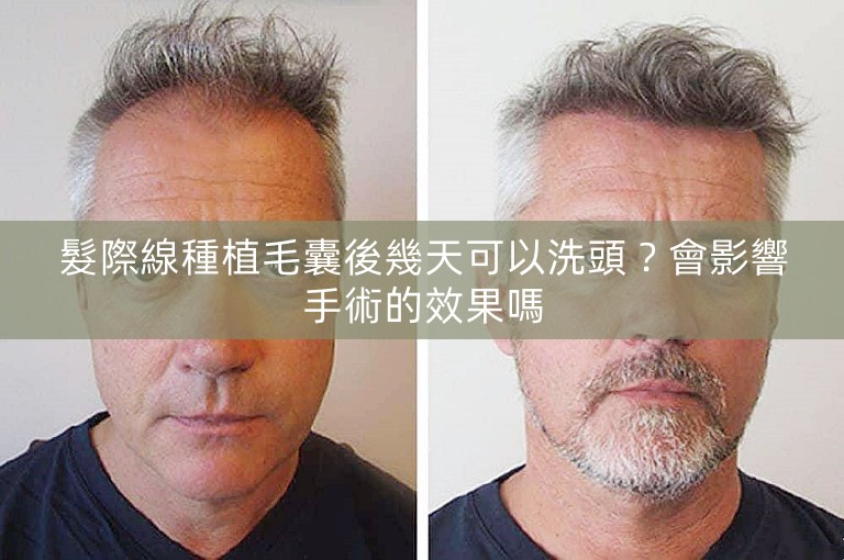 髮際線種植毛囊後幾天可以洗頭？會影響手術的效果嗎