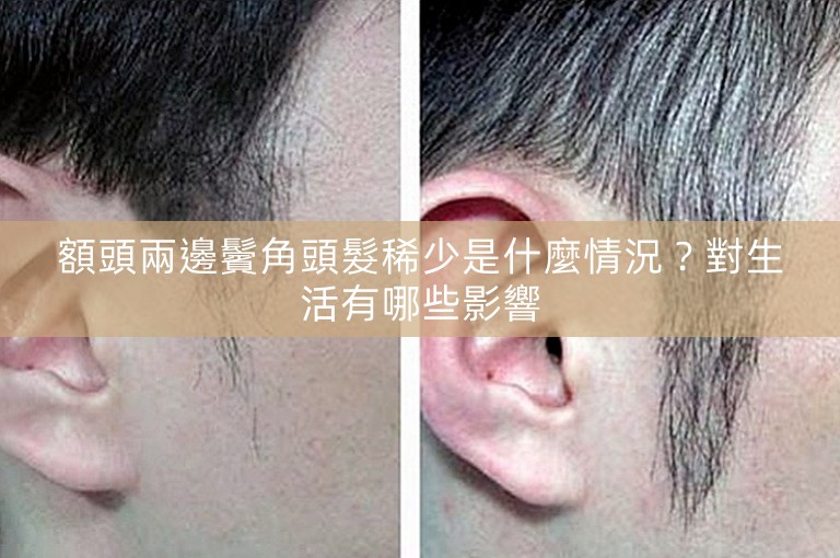 額頭兩邊鬢角頭髮稀少是什麼情況？對生活有哪些影響