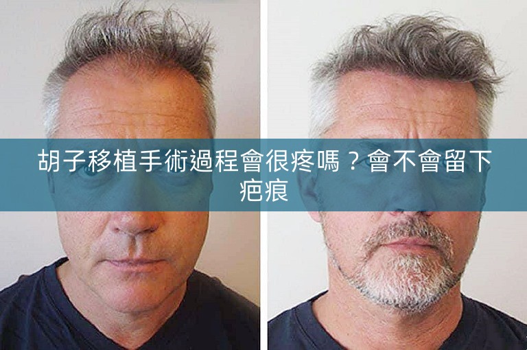 胡子移植手術過程會很疼嗎？會不會留下疤痕