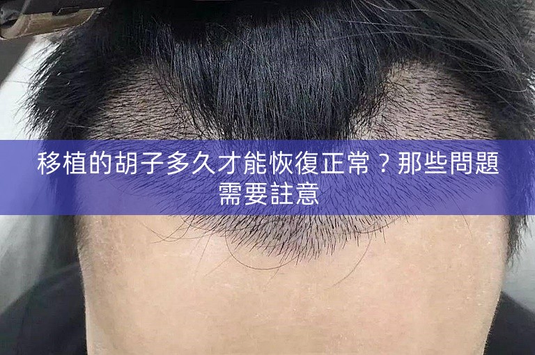 移植的胡子多久才能恢復正常？那些問題需要註意