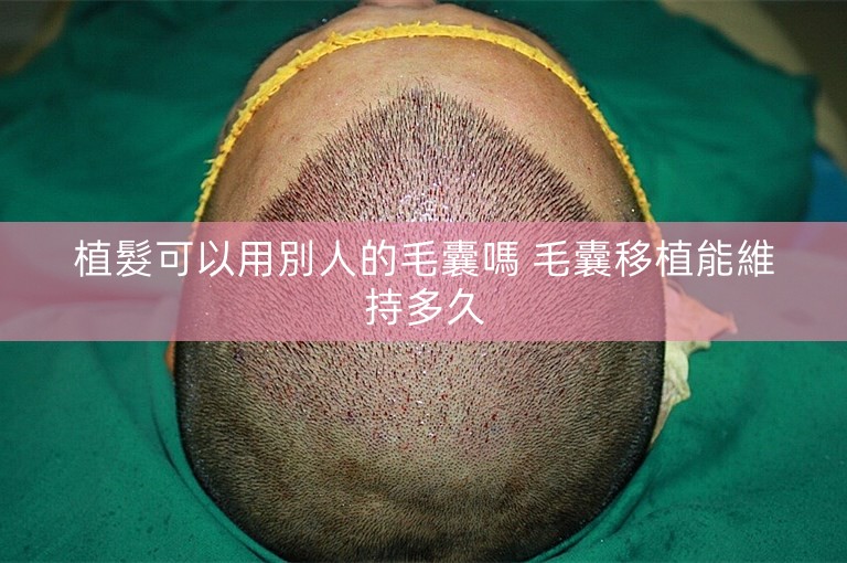 植髮可以用別人的毛囊嗎 毛囊移植能維持多久