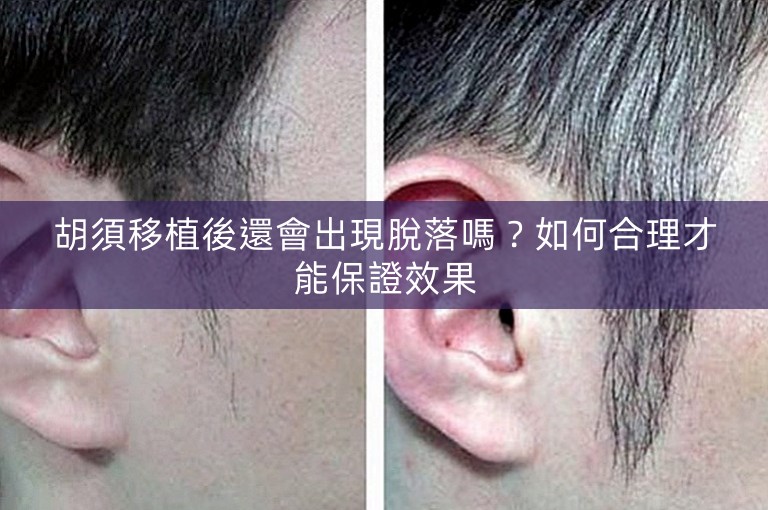 胡須移植後還會出現脫落嗎?如何合理才能保證效果 胡須移植後還會出現脫落嗎?如何合理才能保證效果