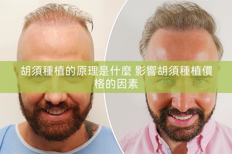 胡須種植的原理是什麼 影響胡須種植價格的因素 胡須種植的原理是什麼 影響胡須種植價格的因素