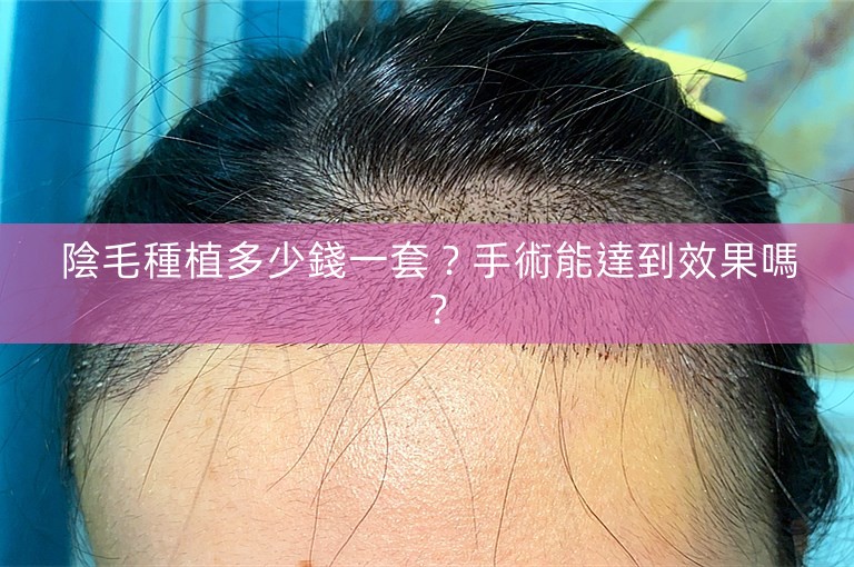 陰毛種植多少錢一套?手術能達到效果嗎? 陰毛種植多少錢一套?手術能達到效果嗎?