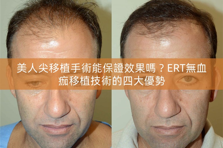 美人尖移植手術能保證效果嗎？ERT無血痂移植技術的四大優勢