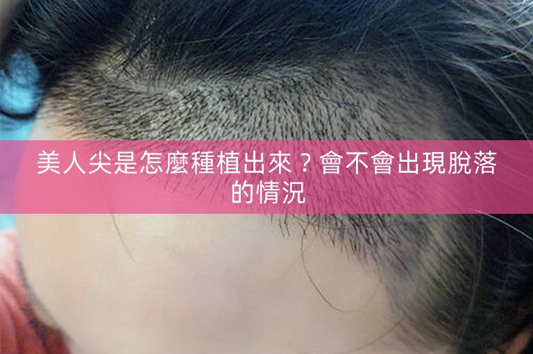 美人尖是怎麼種植出來？會不會出現脫落的情況