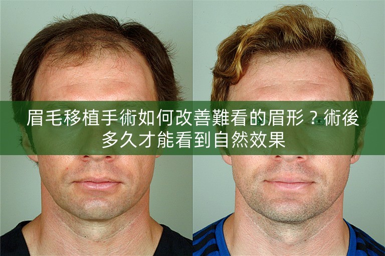 眉毛移植手術如何改善難看的眉形？術後多久才能看到自然效果